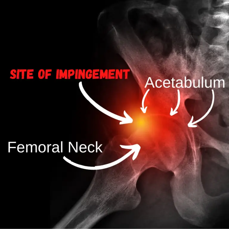 Sudden Sharp Hip Pain Common Causes And Proven Treatments Facts Physio