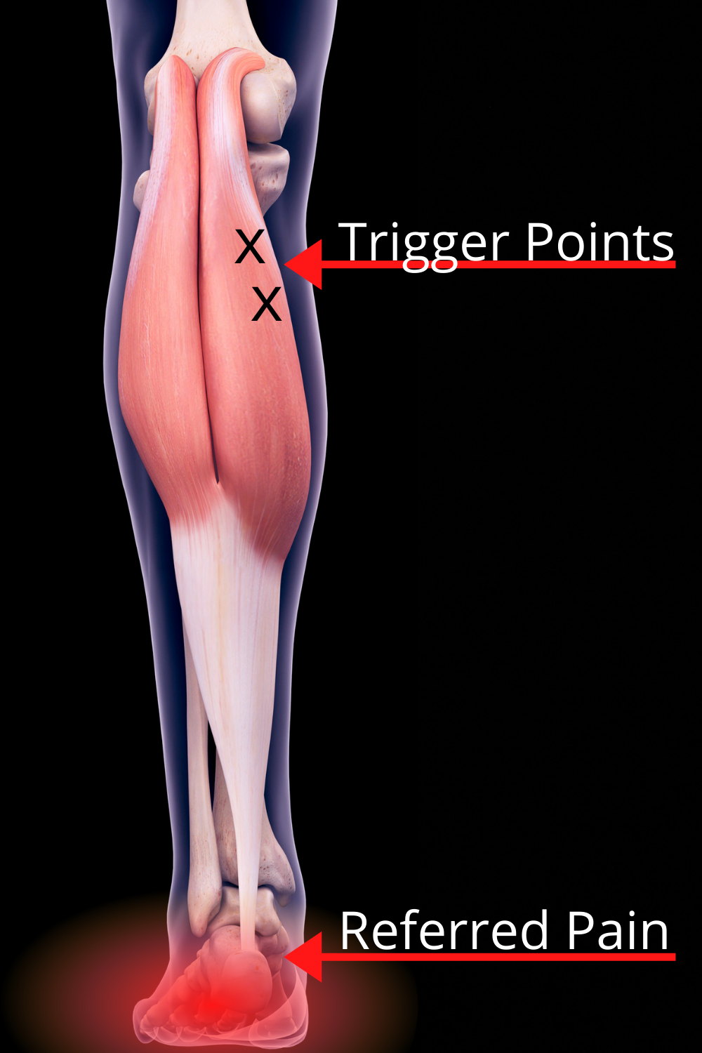 The Authoritative Guide to Dry Needling - Facts & Physio