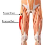 How to Fix TFL Muscle Pain (Tensor Fasciae Latae) - Facts & Physio