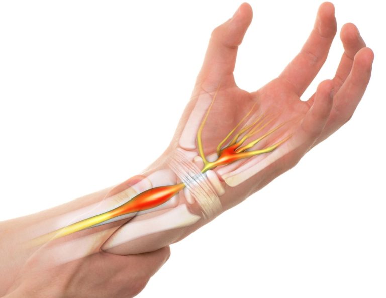 how-to-get-rid-of-arm-pain-and-tingling-hands-i-liebscher-bracht